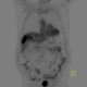 Liver metastasis of adenocarcinoma of colon, colorectal carcinoma, biopsy: NM - Nuclear medicine